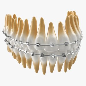 Teeth with Braces Model 3D