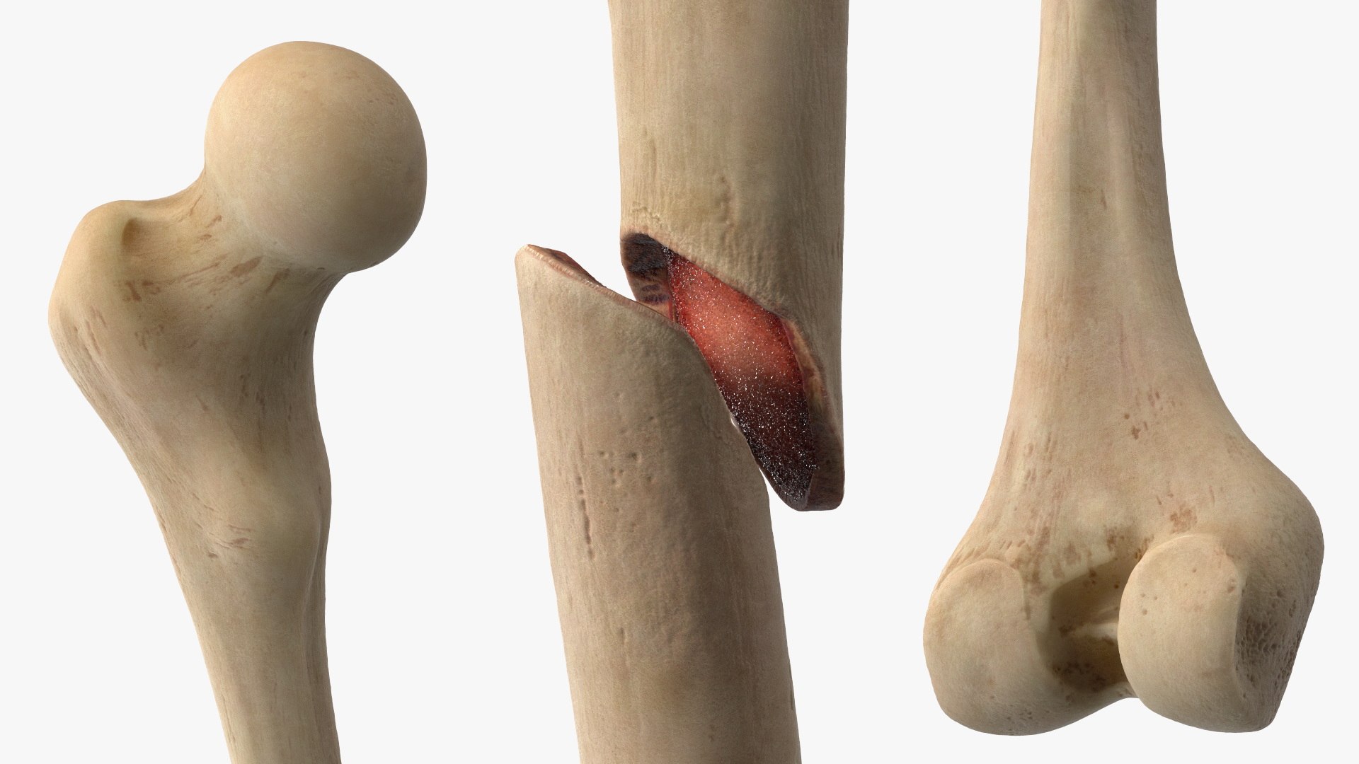 3D Femur Bone with Complete Fracture https://p.turbosquid.com/ts-thumb/9W/uOJLFo/4L/femur_bone_with_complete_fracture_005/jpg/1782799952/1920x1080/fit_q87/8d5235966f7148031a40962d22322fbf8210681b/femur_bone_with_complete_fracture_005.jpg