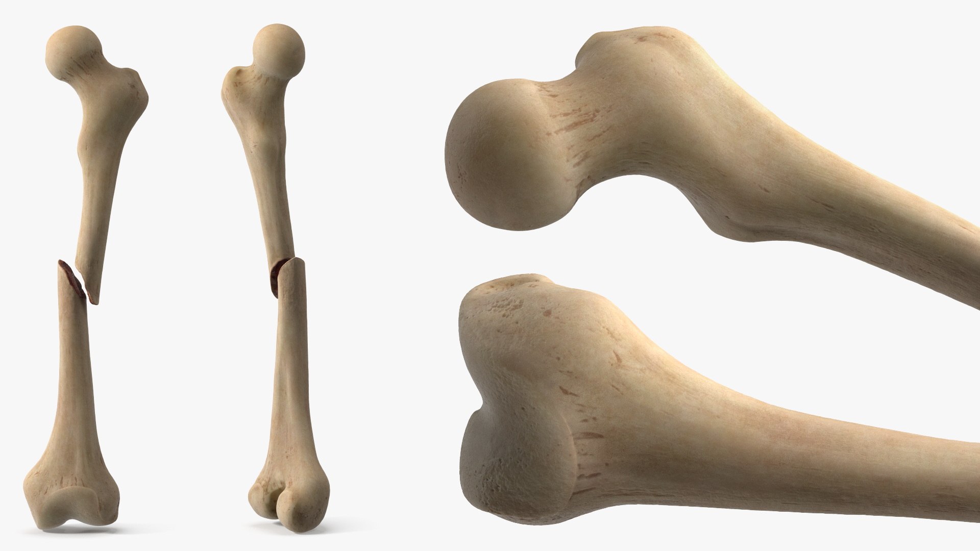 3D Femur Bone with Complete Fracture https://p.turbosquid.com/ts-thumb/9W/uOJLFo/7v/femur_bone_with_complete_fracture_004/jpg/1782799949/1920x1080/fit_q87/cc2f47590c0fc1bbf41c693e1733eadb4ec37142/femur_bone_with_complete_fracture_004.jpg