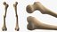 Femur Bone with Complete Fracture