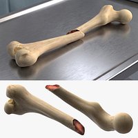 Femur Bone with Complete Fracture