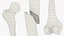 Femur Bone with Complete Fracture