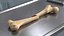Femur Bone with Complete Fracture