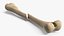 Femur Bone with Complete Fracture