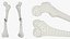 Femur Bone with Complete Fracture