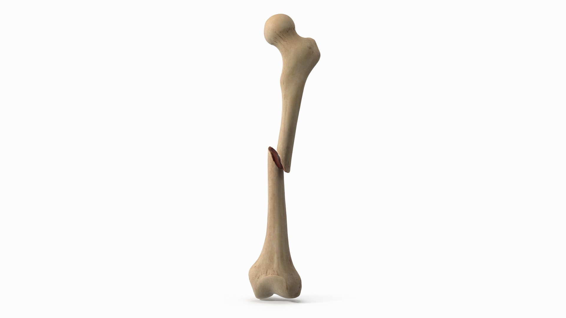 3D Femur Bone with Complete Fracture https://p.turbosquid.com/ts-thumb/9W/uOJLFo/cR/femur_bone_with_complete_fracture_360/jpg/1782799899/1920x1080/turn_fit_q99/0267eefdd748d55c20240e595198879fa64ed971/femur_bone_with_complete_fracture_360-1.jpg