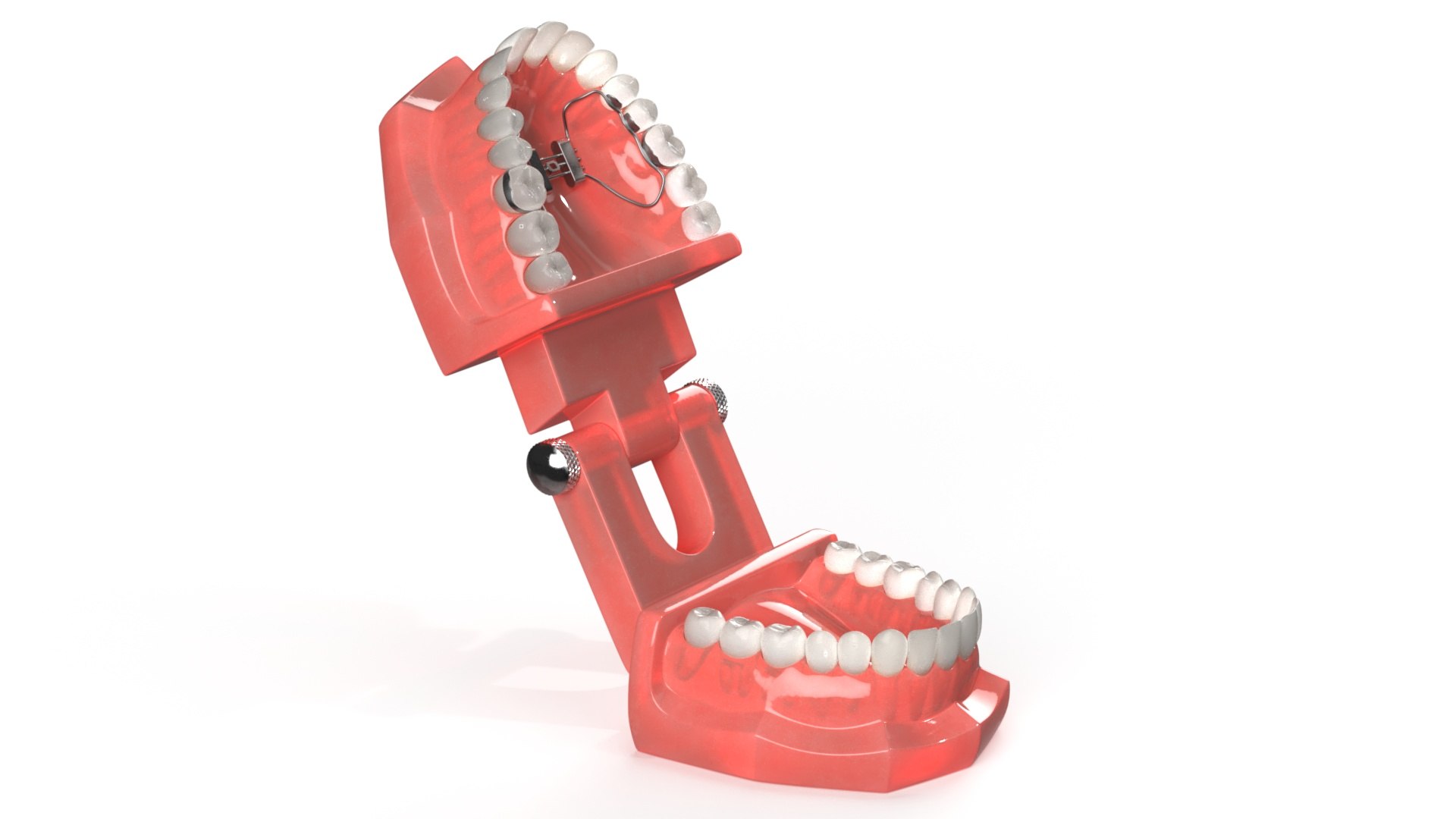 Orthodontic Palatal Expander Mounted on Teeth 3D model preview