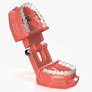 3D Orthodontic Palatal Expander Mounted on Teeth model