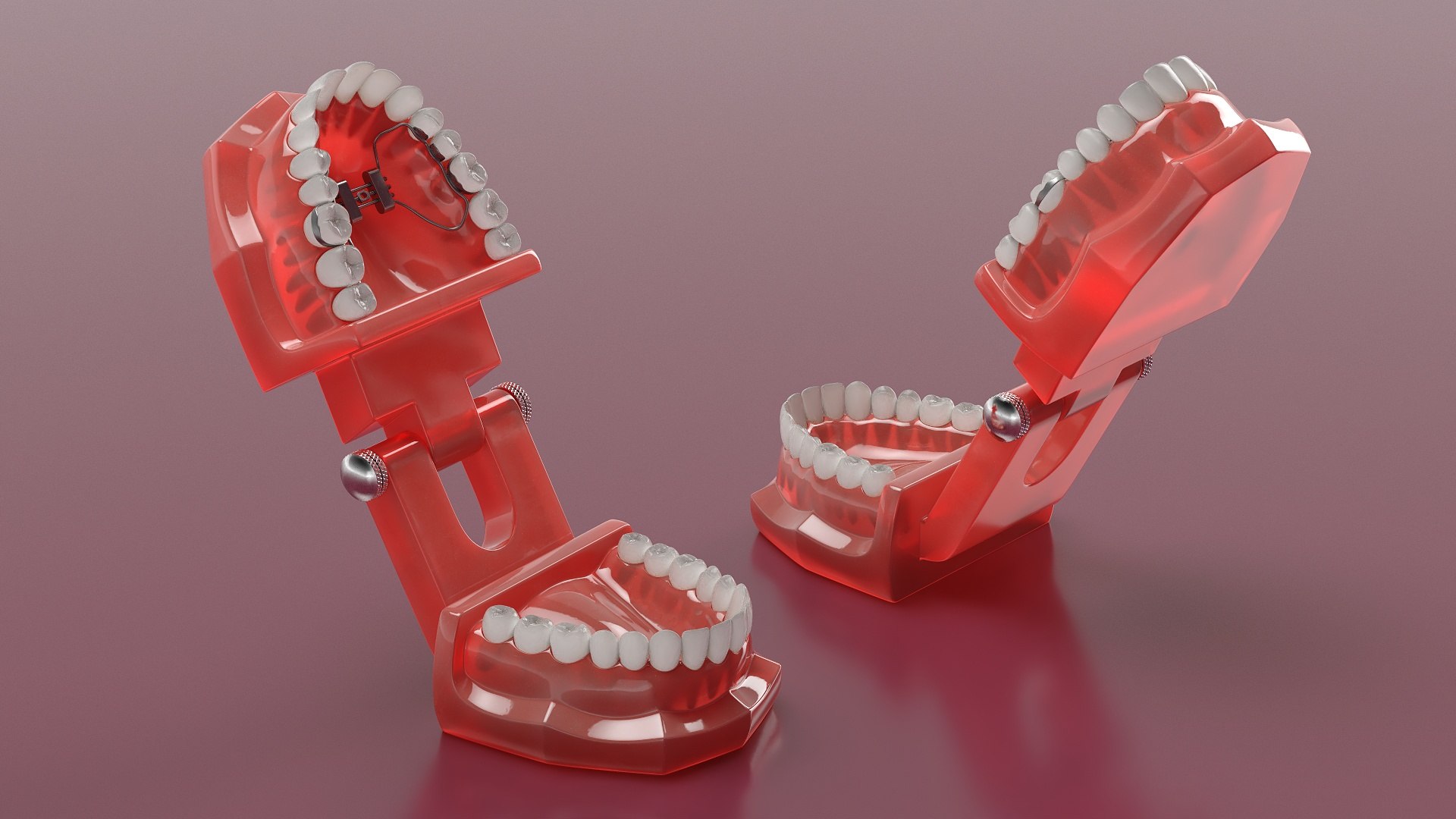 3D Orthodontic Palatal Expander Mounted On Teeth Model - TurboSquid 2447705