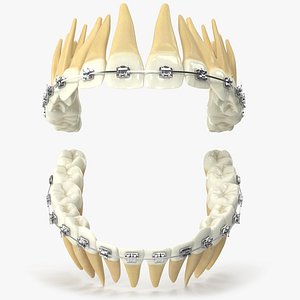 3D Human Teeth With Self Ligating Steel Dental Braces V03