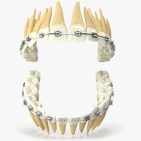 Human Teeth With Self Ligating Steel Dental Braces V03