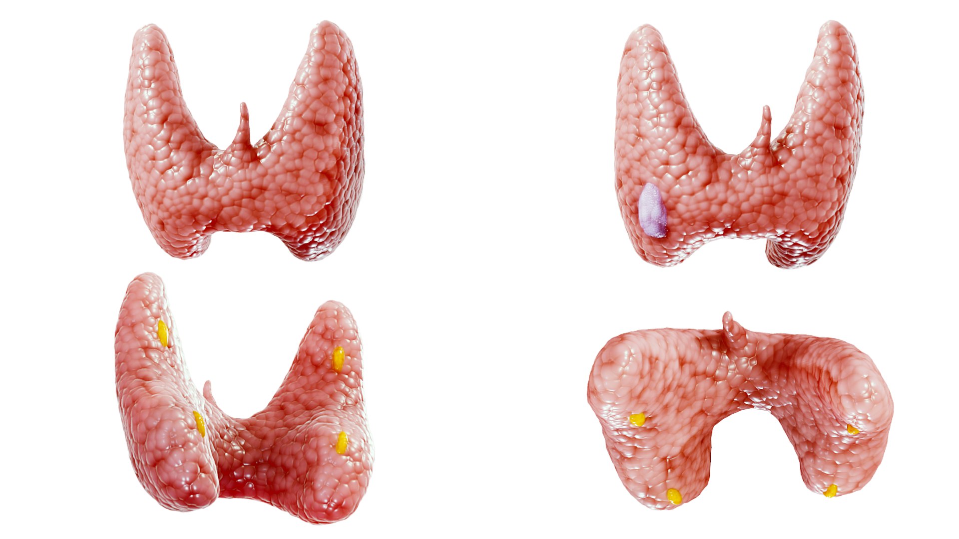 Healthy Thyroid and Thyroid Cancer 3D model https://p.turbosquid.com/ts-thumb/9y/kFilsX/bi/thyroid_render/png/1695893918/1920x1080/fit_q87/d39160ad6c11ee6a71d9a6e0d934d6132da36d76/thyroid_render.jpg