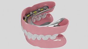 3D model Hibrid implant bar attachment