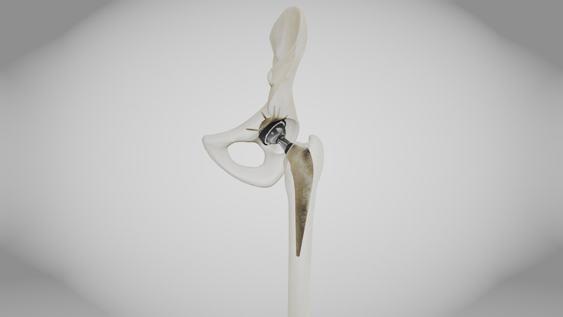 3D Replaced Hip Implant https://p.turbosquid.com/ts-thumb/AU/loYHzG/CR/replaced_hip_implant10/jpg/1696274693/1920x1080/fit_q87/b9d89b71b27e51ab61b57b09976c3fb843bc92c3/replaced_hip_implant10.jpg