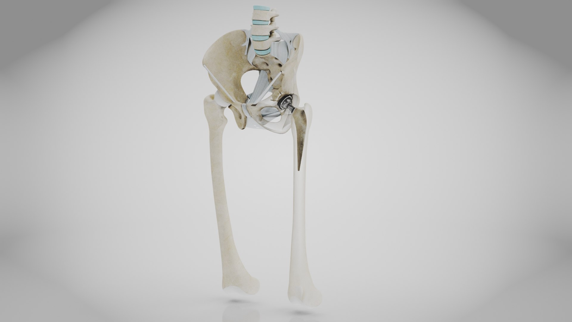 3D Replaced Hip Implant https://p.turbosquid.com/ts-thumb/AU/loYHzG/Cr/replaced_hip_implant4/jpg/1696274684/1920x1080/fit_q87/0455f842ee95d6647febc91de2769be5e0e9d5f6/replaced_hip_implant4.jpg