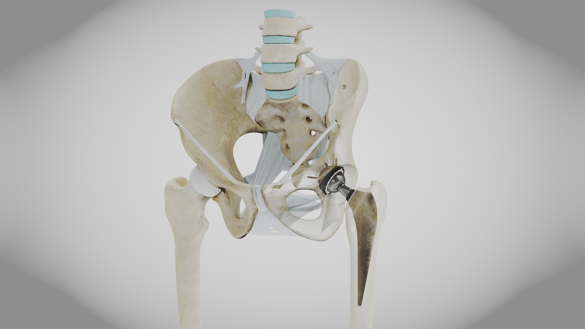 3D Replaced Hip Implant https://p.turbosquid.com/ts-thumb/AU/loYHzG/b0/w/jpg/1696274171/1920x1080/turn_fit_q99/23cd63efeed5582d73695a0f6ec0399cec573738/w-1.jpg