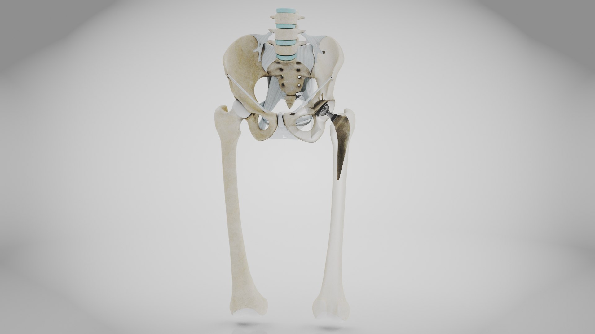 3D Replaced Hip Implant https://p.turbosquid.com/ts-thumb/AU/loYHzG/oi/replaced_hip_implant2/jpg/1696274681/1920x1080/fit_q87/2eef44c6ea223753cf1cf0dfb5421d01d4ec7fcc/replaced_hip_implant2.jpg