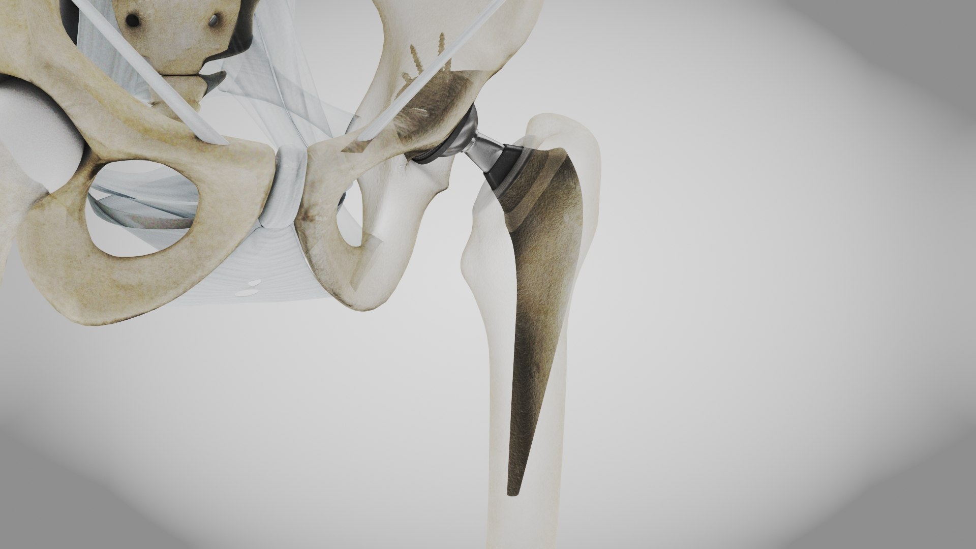 3D Replaced Hip Implant https://p.turbosquid.com/ts-thumb/AU/loYHzG/qx/replaced_hip_implant7/jpg/1696274688/1920x1080/fit_q87/19bc03dbb53a1ed6e573149322dc78d41c5fd0eb/replaced_hip_implant7.jpg