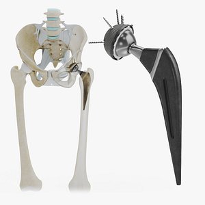 Replaced Hip Implant