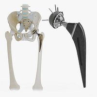 Replaced Hip Implant