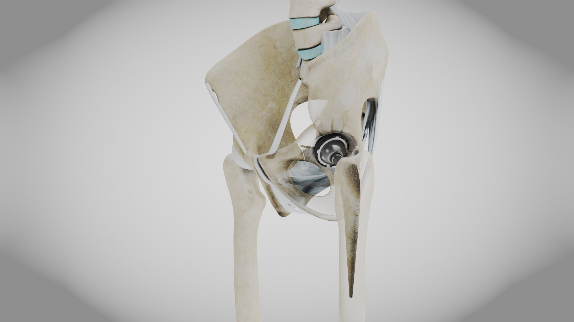 3D Replaced Hip Implant https://p.turbosquid.com/ts-thumb/AU/loYHzG/vw/replaced_hip_implant9/jpg/1696274694/1920x1080/fit_q87/0121fef2297ef3df02233e488b964be33c5aa3b2/replaced_hip_implant9.jpg