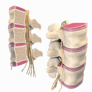 Slipped Bulging Herniated Herniation Disc Spine model