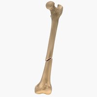 Oblique Fracture