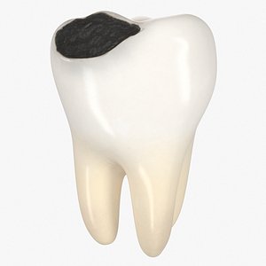 3D teeth decay