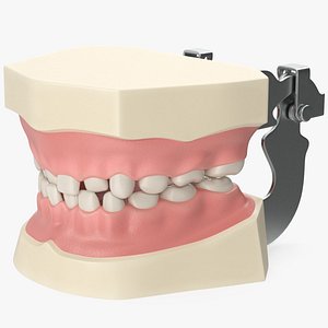 3D Dental Anatomy Model Simulation with Removable Crossbite Teeth