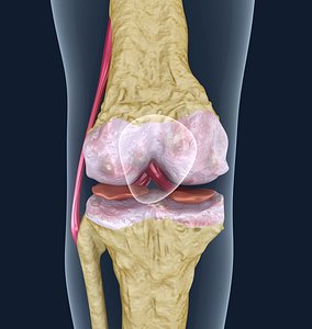 Osteoporosis of the knee joint.