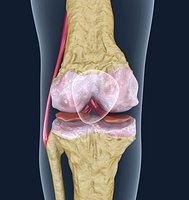 Osteoporosis of the knee joint.