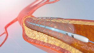3D model blood stent