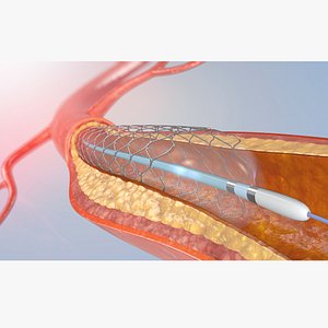 3D model blood stent