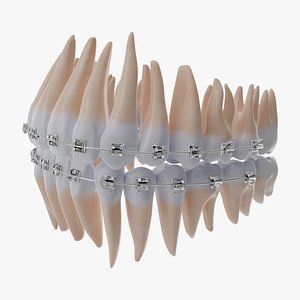 braces orthodontics 3D model