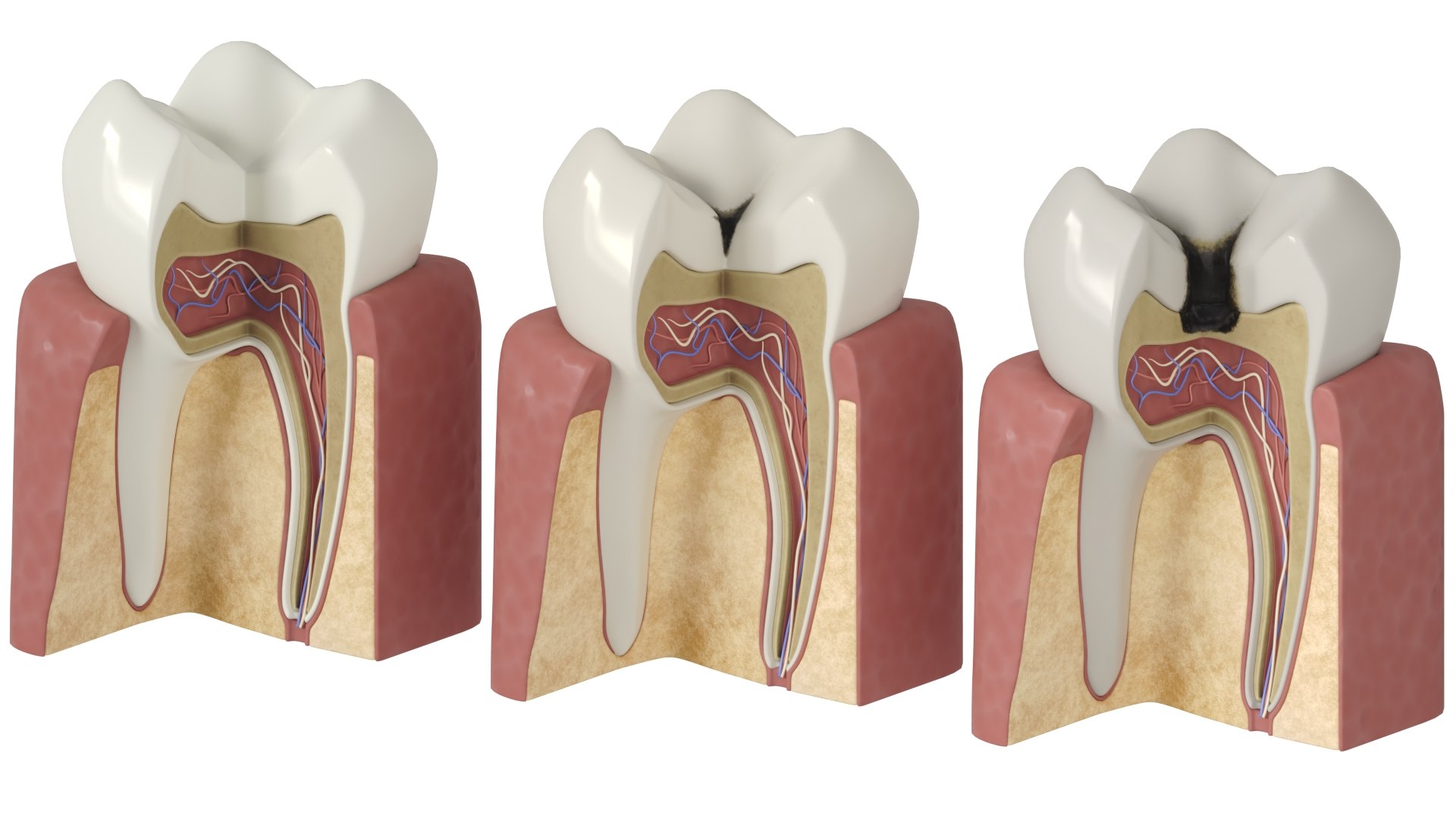 Tooth Decay Stages Cavity Caries 3D Model - TurboSquid 1887620