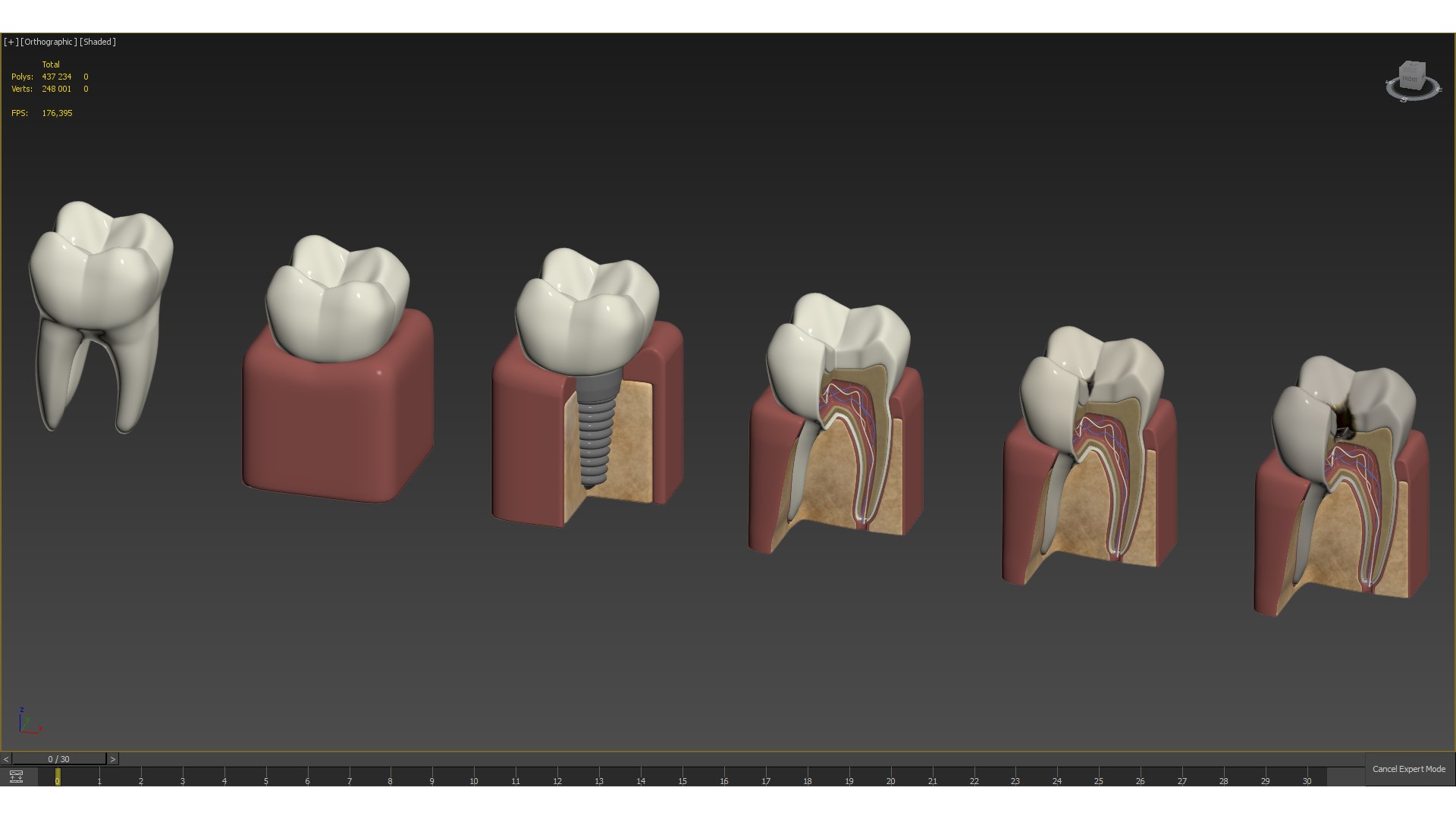 Tooth Decay Stages Cavity Caries 3D Model - TurboSquid 1887620
