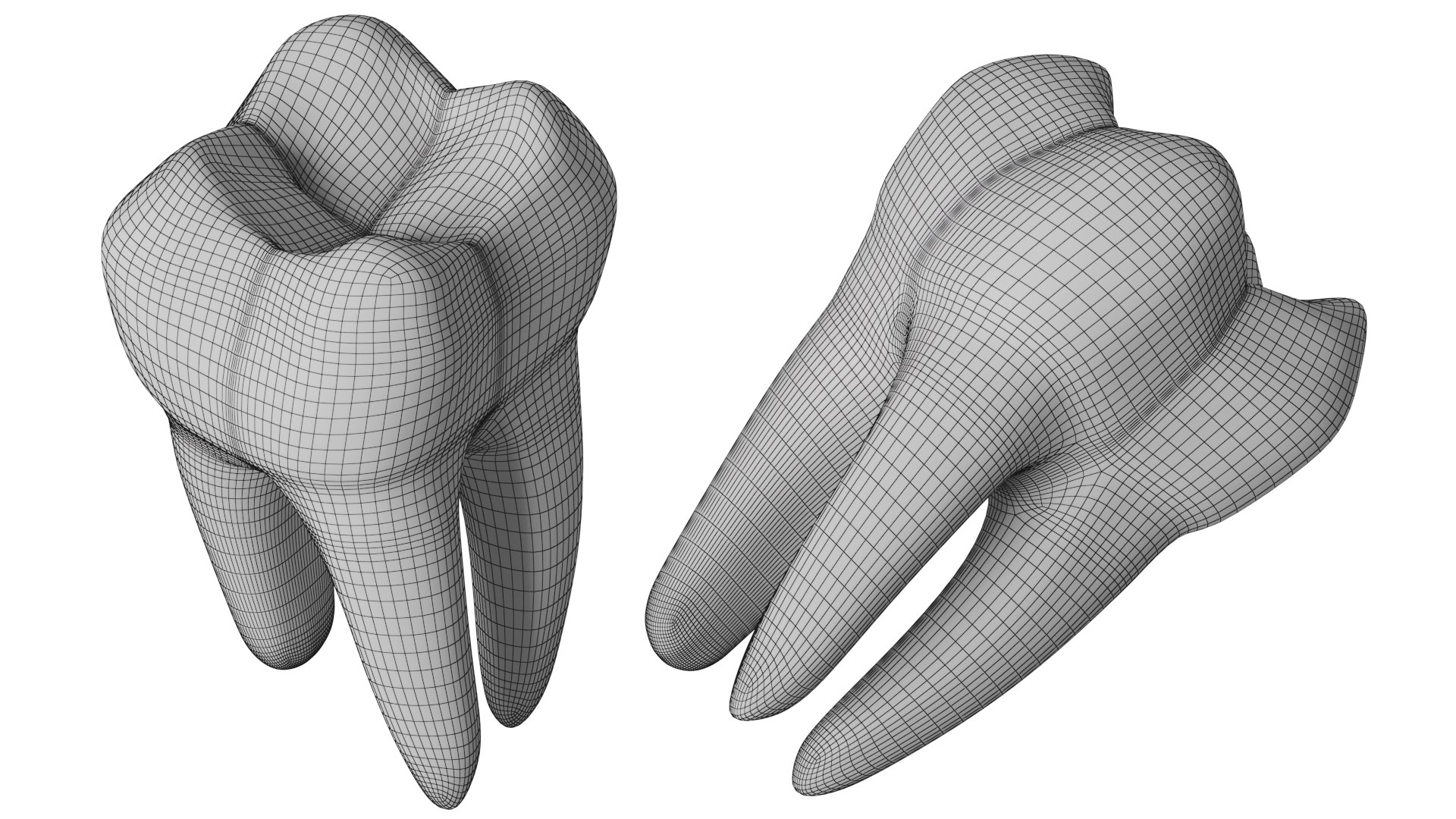 Tooth Decay Stages Cavity Caries 3D Model - TurboSquid 1887620