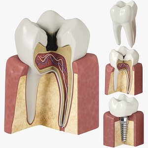 Tooth decay stages cavity caries 3D model