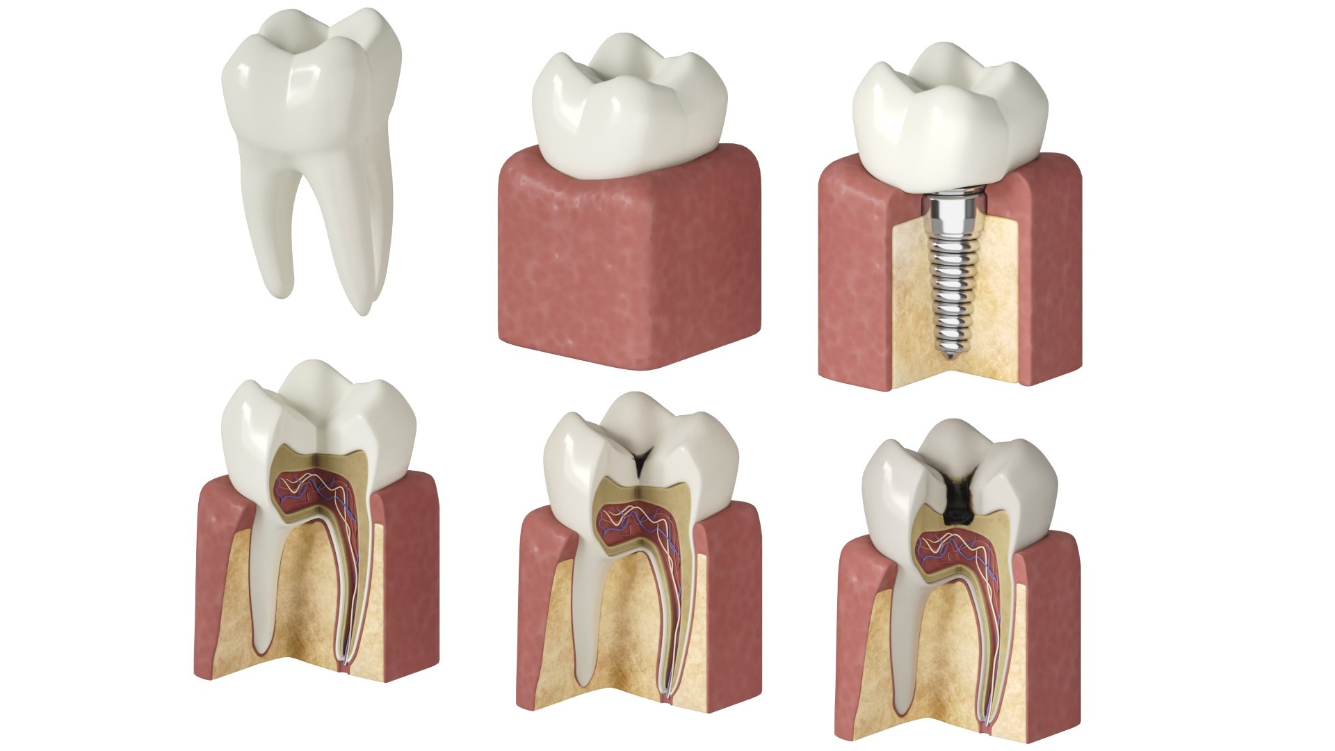 Tooth Decay Stages Cavity Caries 3D Model - TurboSquid 1887620