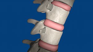 3d model spine spinal decompression