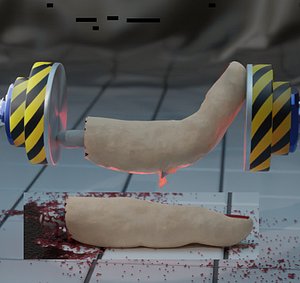 Severed and broken finger