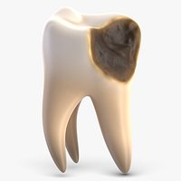 Tooth 3 with Cavity
