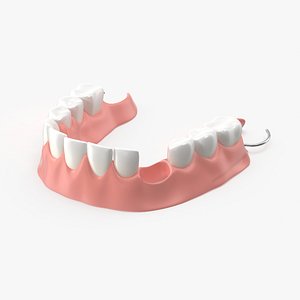3D Jaw Prosthesis