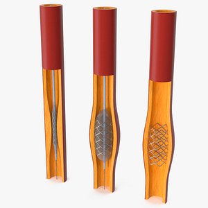 Plastic Models of Stents with Artery 3D model