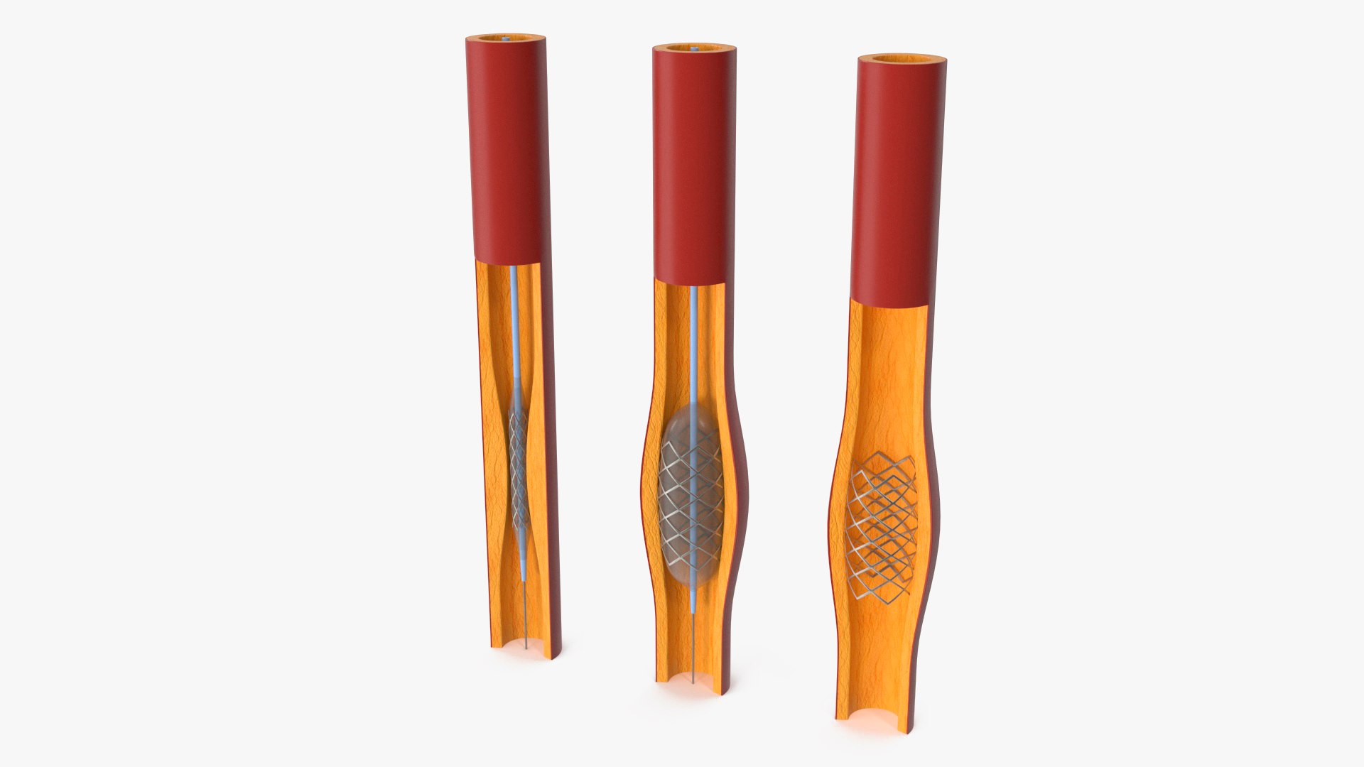Plastic Models of Stents with Artery 3D model preview