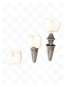 Dental metal repair model