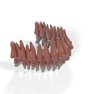 Ligature-Free Braces on Plastic Teeth for 3D Print 3D model