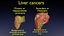3D Liver cancer HCC vs Metastatic