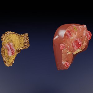 3D Liver cancer HCC vs Metastatic