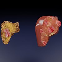 Liver cancer HCC vs Metastatic